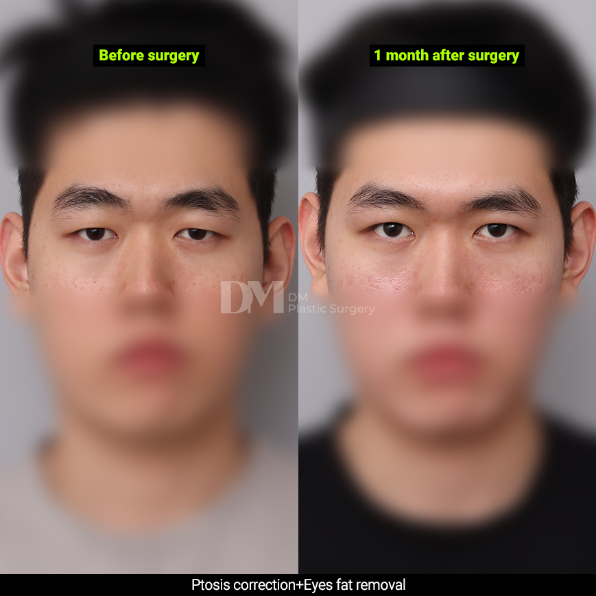 /images/en/Eyes_EyesSurgery/plastic surgery in korea_eyes surgeryBA10.jpg